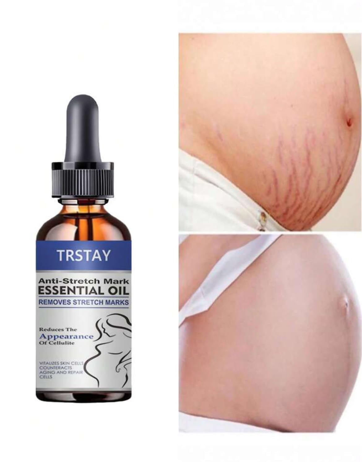 Stretch marks remover Smooth Fine Lines, Moisturize, Smooth, Firm, Repair Fade Wrinkles stretch marks